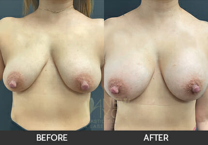 Breast Augmentation Gallery