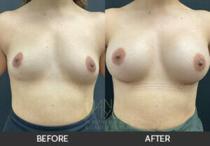 Breast Augmentation Before and After, Chicago, IL