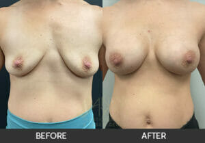 Breast Augmentation Before and After, Chicago, IL