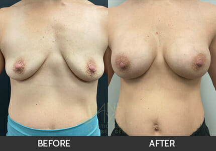 Breast Augmentation Gallery