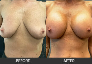 Breast Augmentation Before and After, Chicago, IL