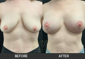 Breast Lift with Augmentation Before and After, Chicago, IL