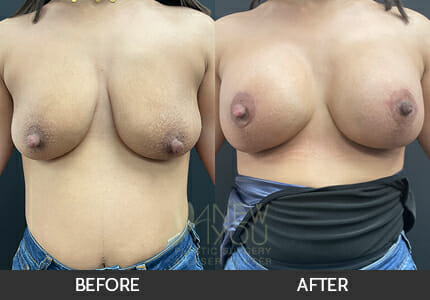 Breast Augmentation with Lift (Mastopexy) Gallery