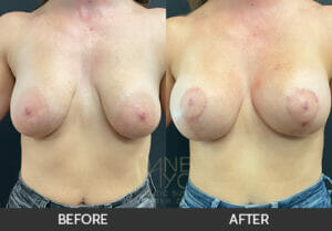 Breast Lift with Augmentation Before and After, Chicago, IL