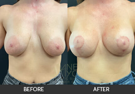 Breast Augmentation with Lift (Mastopexy) Gallery