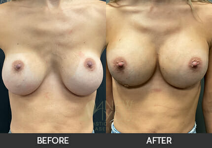 Breast Revision Gallery