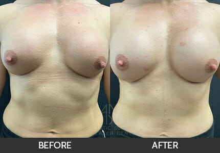 Breast Revision Gallery