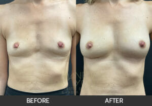 Breast Revision Before and After, Chicago, IL