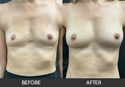 Breast Revision Gallery