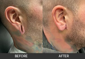 Earlobe Repair Before and After, Chicago, IL