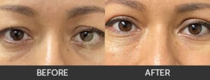 Eyelid Lift Before and After, Chicago, IL