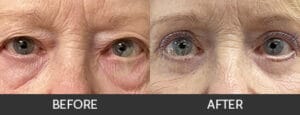 Eyelid Lift Before and After, Chicago, IL