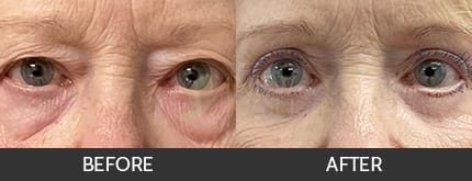 Eyelid Lift Gallery