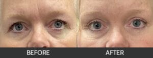 Eyelid Lift Before and After, Chicago, IL