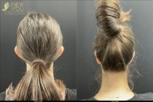 Ear Pinning Example from ANewYou