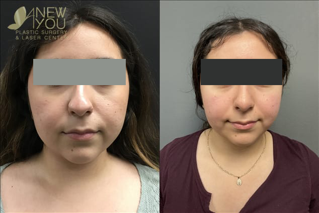 Nose Surgery Example 2