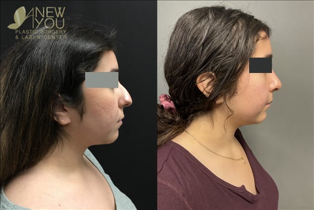 Nose Surgery Example