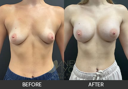 Breast Augmentation Gallery