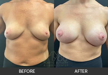 Breast Augmentation Gallery