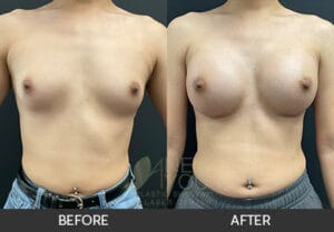 Breast Augmentation Before and After, Chicago, IL