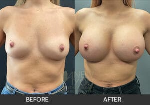 Breast Augmentation Before and After, Chicago, IL