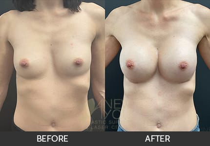 Breast Augmentation Gallery