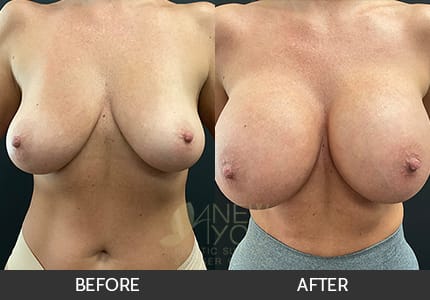 Breast Augmentation Gallery