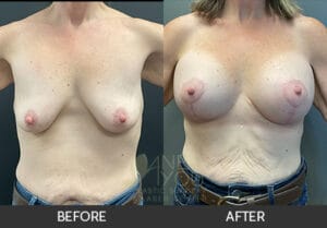 Breast Lift with Augmentation Before and After, Chicago, IL