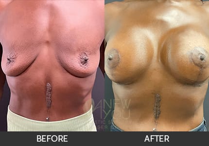 Breast Augmentation with Lift (Mastopexy) Gallery