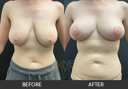 Breast Lift Gallery