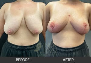Breast Lift Before and After, Chicago, IL