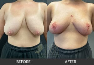 Breast Lift Gallery