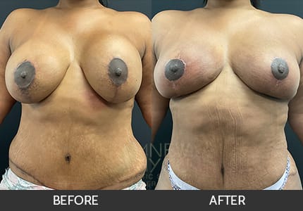 Breast Revision Gallery