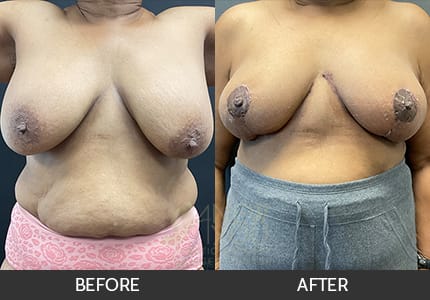 Breast Revision Gallery