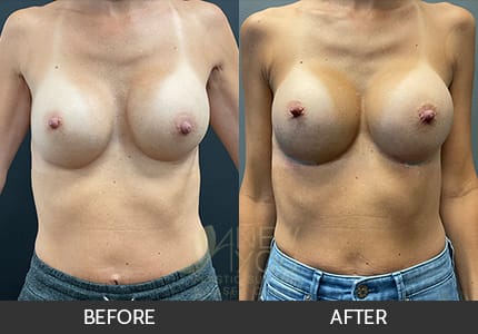 Breast Revision Gallery