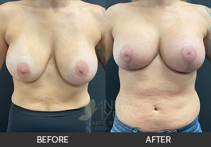 Breast Revision Gallery