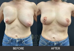 Breast Revision Before and After, Chicago, IL