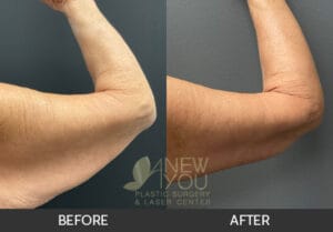 Arm Lift (Brachioplasty) Before and After - Chicago, IL