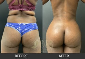 Brazilian Butt Lift Before and After, Chicago, IL