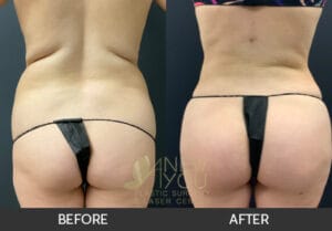 Brazilian Butt Lift Before and After, Chicago, IL