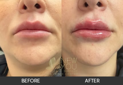 Lip Augmentation Gallery