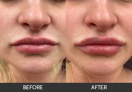 Lip Augmentation Gallery