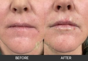 Lip Augmentation Before and After - Chicago, IL