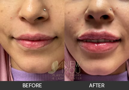 Lip Augmentation Gallery