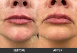 Lip Augmentation Before and After - Chicago, IL