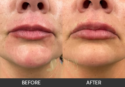 Lip Augmentation Gallery