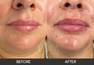 Lip Augmentation Before and After - Chicago, IL