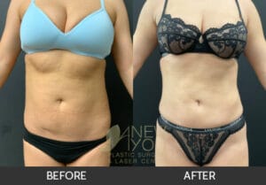 Liposuction Before and After, Chicago, IL