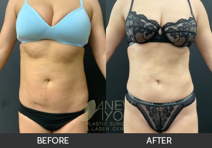 Liposuction Gallery