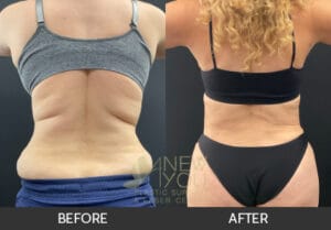 Liposuction Before and After, Chicago, IL